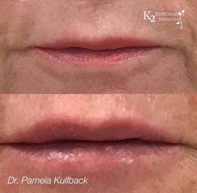 REGISTER TO WIN LIP FILLER