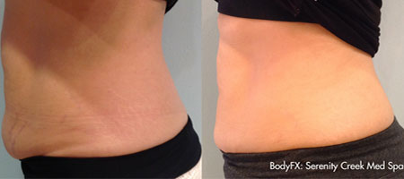 Fat Removal Abdomen