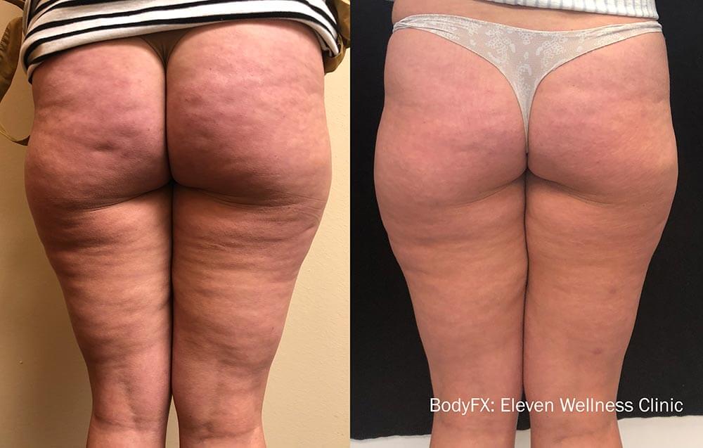 Body Sculpting and Skin Tightening with the BodyFX