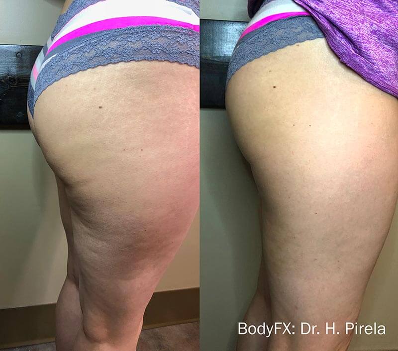 Cellulite Removal Plano TX, Body Contouring Frisco TX