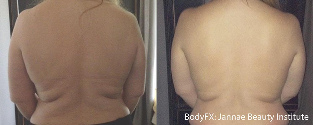 Body Sculpting and Skin Tightening with the BodyFX