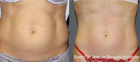 Fat Removal Female Stomach