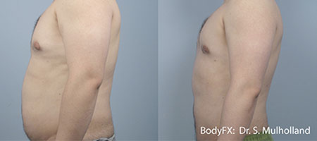 Fat Removal - Male Stomach