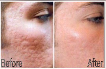 Adult Acne & Acne Scars Birmingham AL - K2 Restorative Medicine