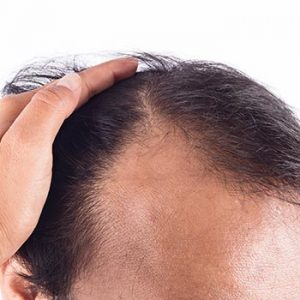 Nonsurgical Hair Loss Solutions at K2 Restorative