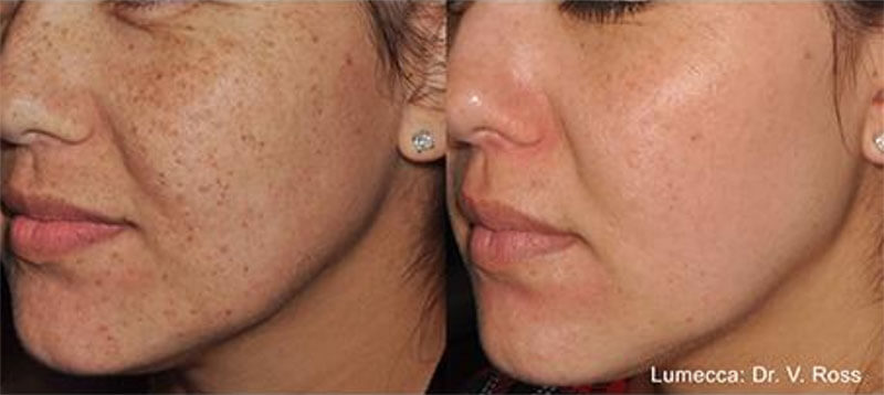 age spot therapy k2 restorative medicine