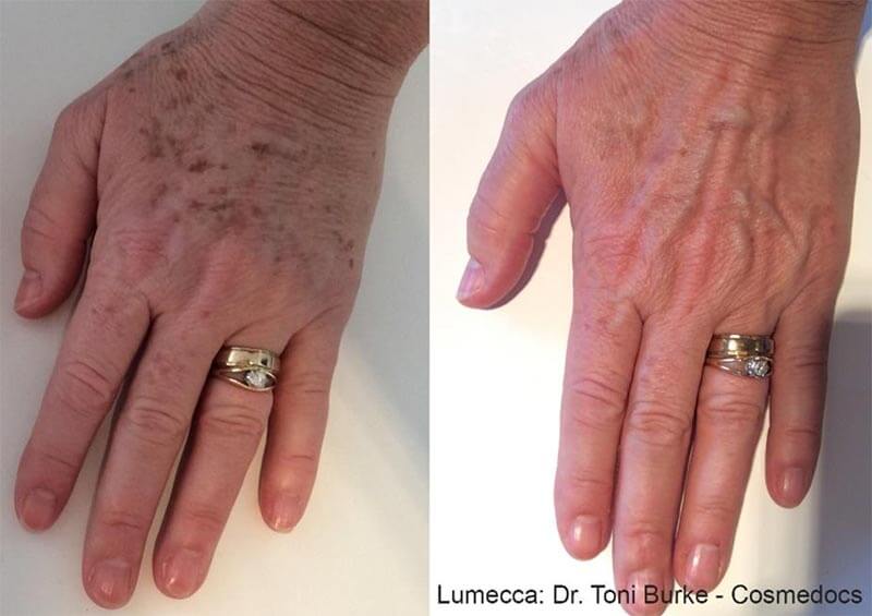 age spot therapy birmingham al
