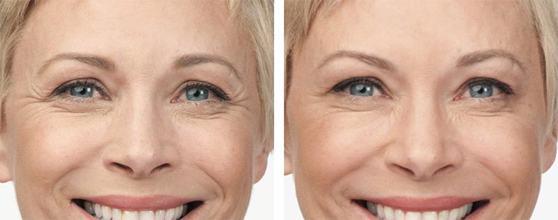 dysport and botox
