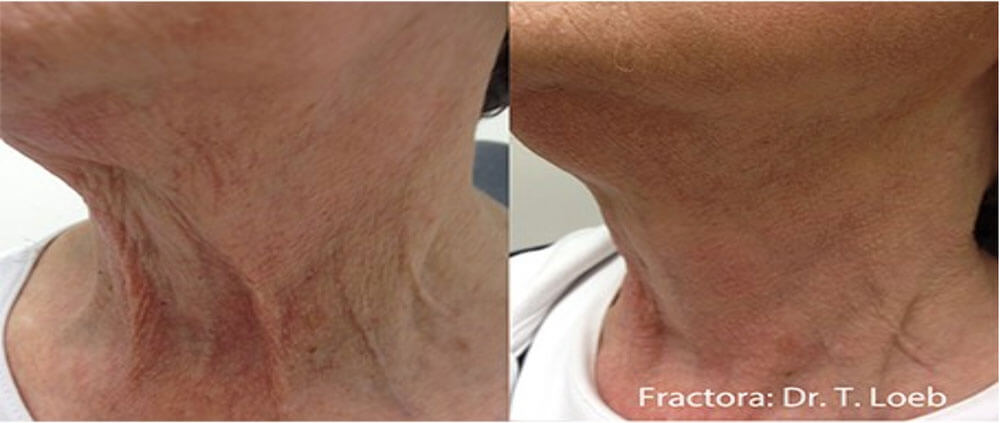 microneedling chin