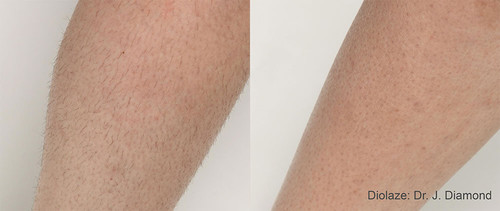 Laser Hair Removal Fast Pain Free Solution with Dr. Pamela Kulback