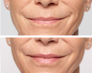 restylane before and after birmingham al