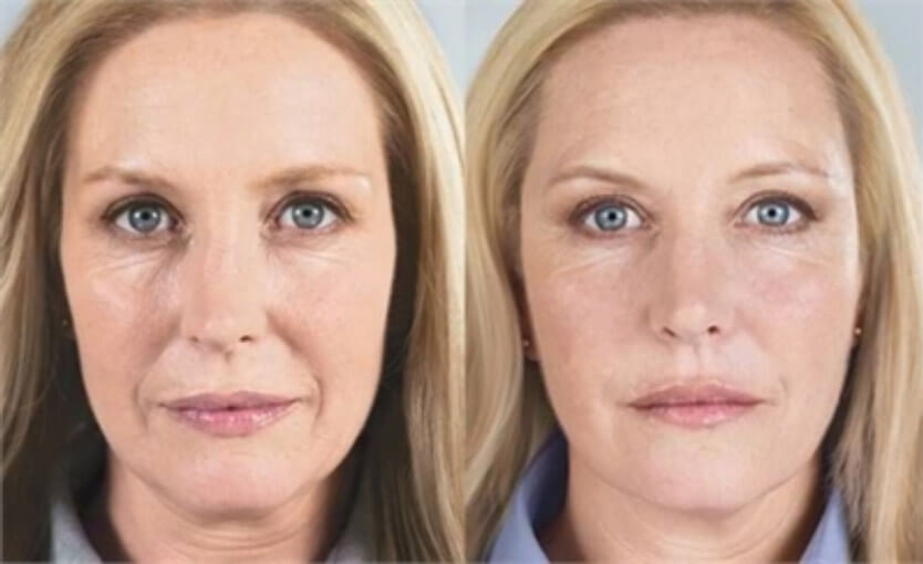 Woman Before and After Sculptra- injectable offered at K2 Restorative Medicine