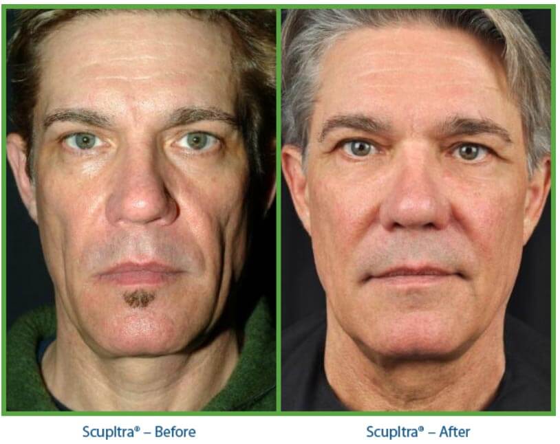 sculptra before and after