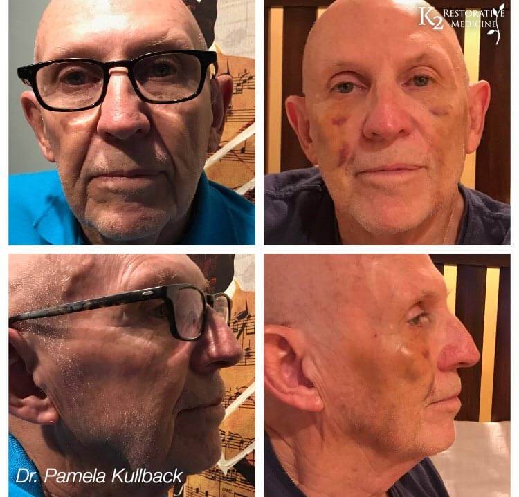 pdo threads before and after - dr kulback