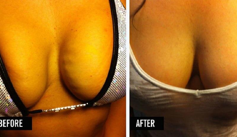 Vampire breast lift permanent