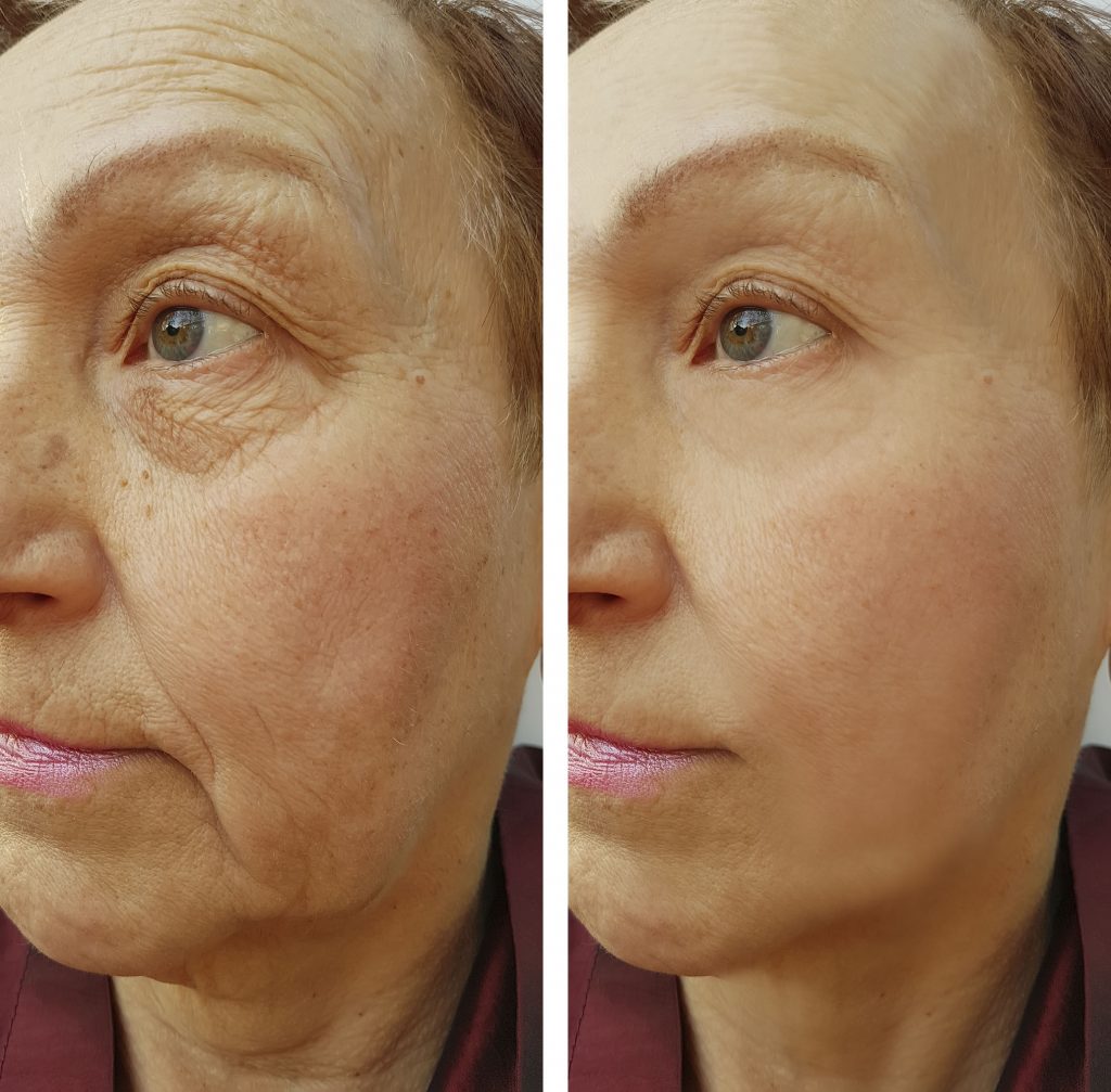 Turn back the Clock with Injectables , Radiofrequency, & More Before and After Treatment Image