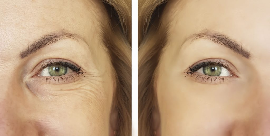 Turn Back the Clock without Surgery