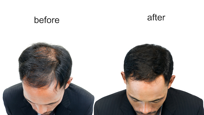 Hair Loss in men and women