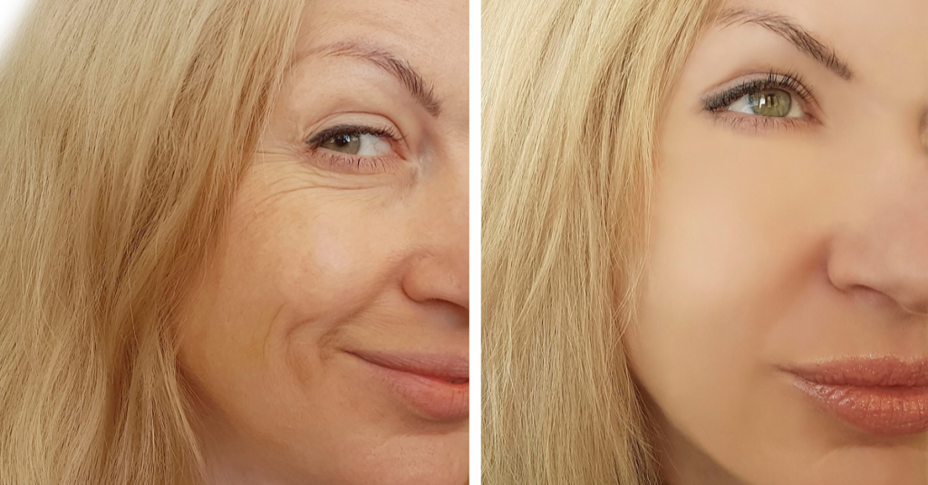Before and After Results of the Sculptra Filler are instantaneous, Patients can expect a dramatic difference while still looking natural. Volumize The Face With Sculptra offered by K2 Restorative Medicine in Birmingham, Alabama (2)