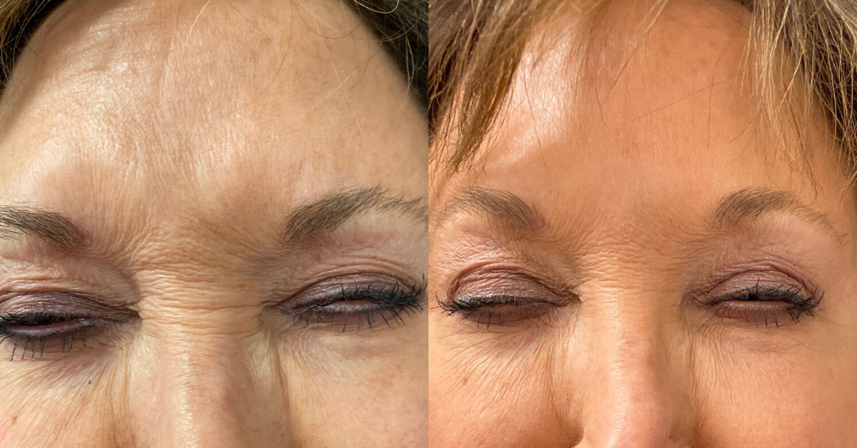 Botox and Dysport for Wrinkles and frown lines in Birmingham Alabama at K2 restorative medicine (3)