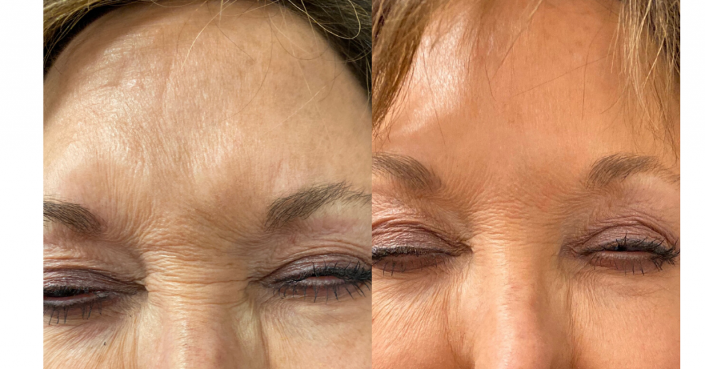 Botox and Dysport for Wrinkles and frown lines in Birmingham Alabama at K2 restorative medicine (3)