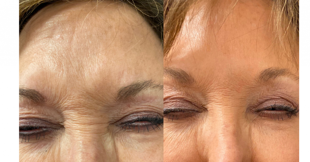 Can Botox Prevent Wrinkles?: Holladay Dermatology & Aesthetics