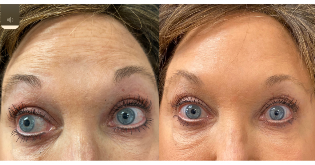 Botox and Dysport for Wrinkles and frown lines in Birmingham Alabama at K2 restorative medicine (3)