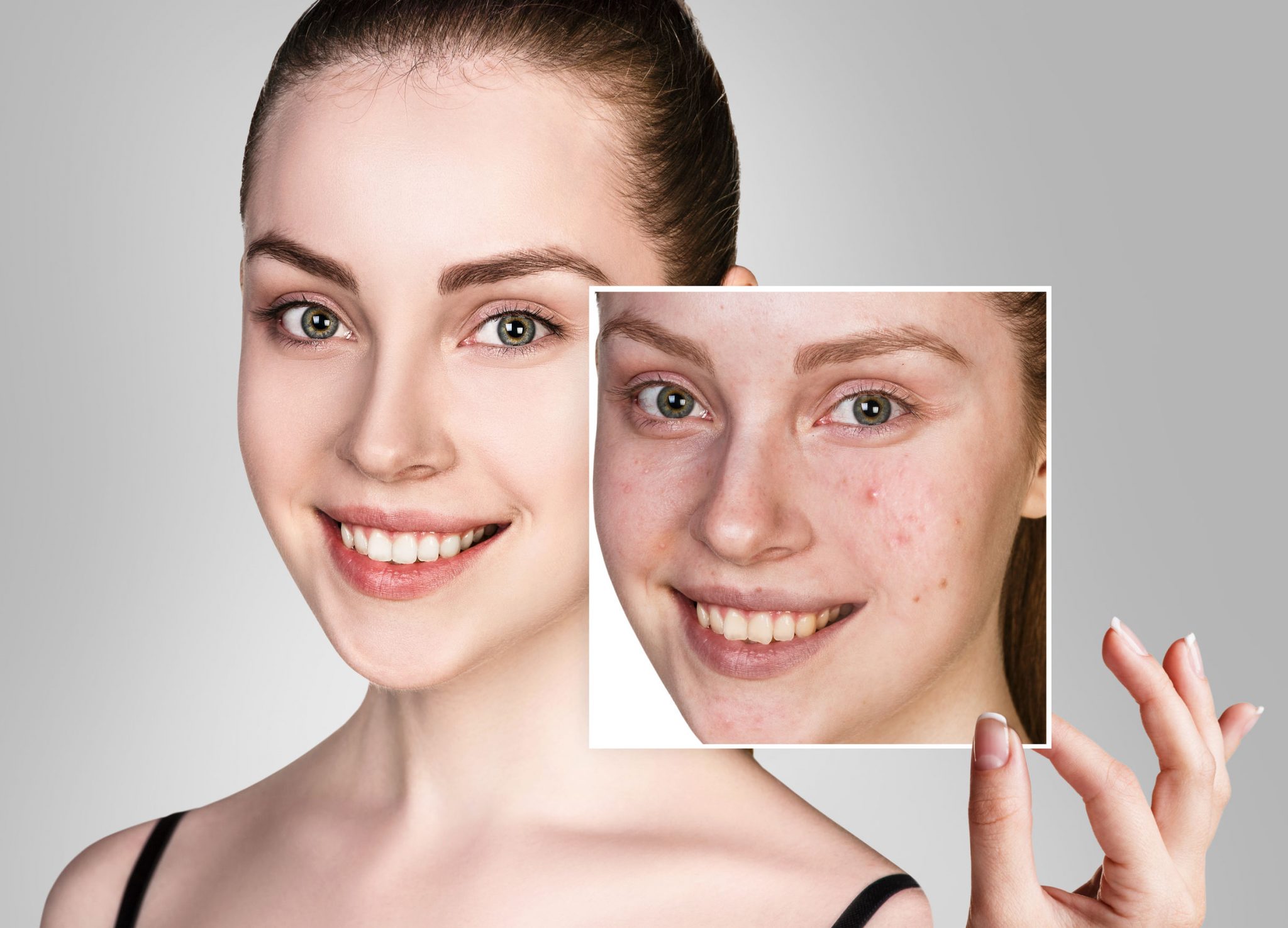 Acne & Acne Scar Treatments with PRP & Microneedling RF