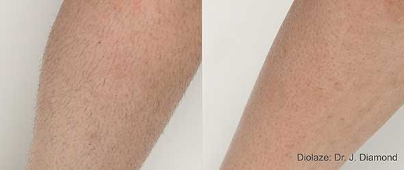 Before and After Diolaze Laser Hair Removal Treatment offered at K2 restorative medicine in Trussville alabama (1)