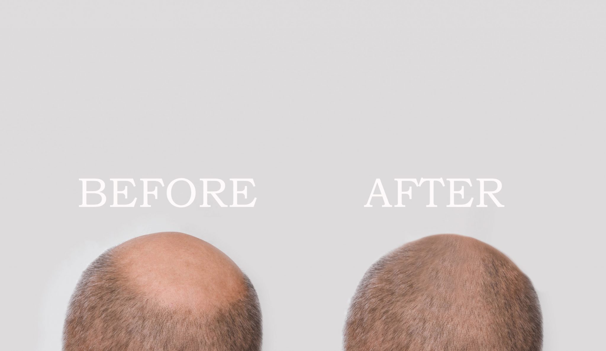 Hair Restoration Before and after