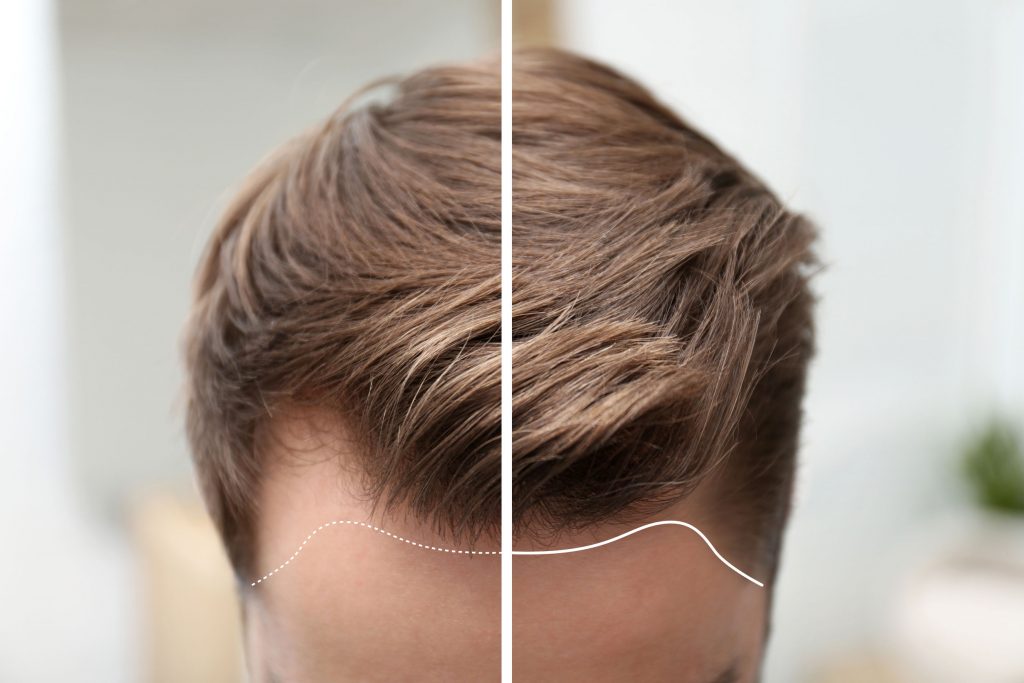 Hair Restoration in Men and women