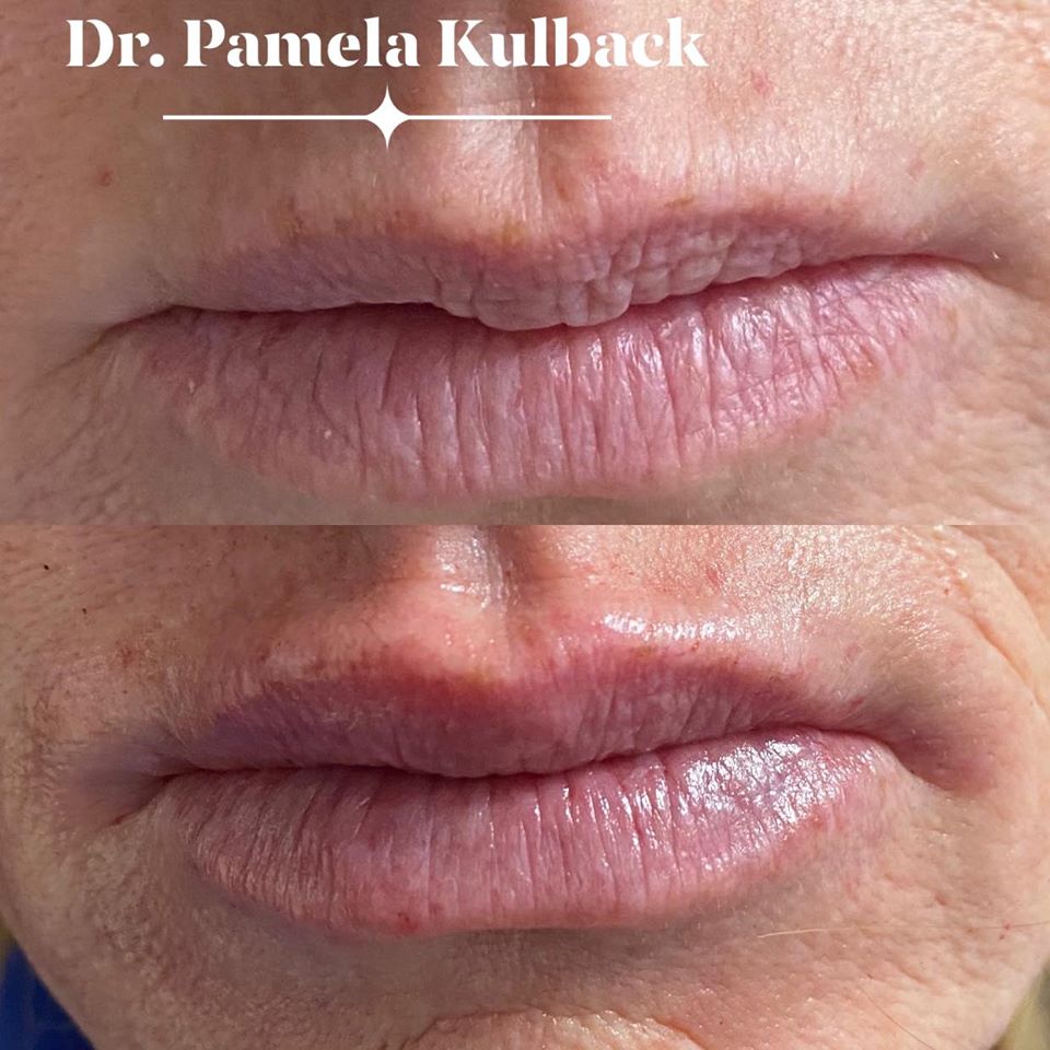 Before and After Kysse Lip Filler with Dr. Pamela Kulback at K2 Restorative Medicine in Trussville, Alabama