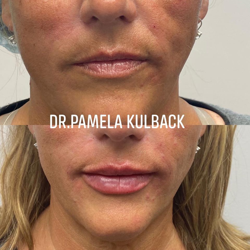 Before and After Restylane Kysse lip filler injection with Dr. Pamela Kulback at K2 Restorative Medicine