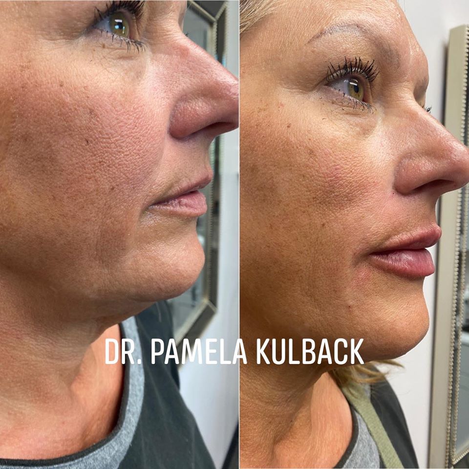 Side view of our patient Before and After Kysse lip filler and PDO Thread-Lift by Dr. Pamela Kulback