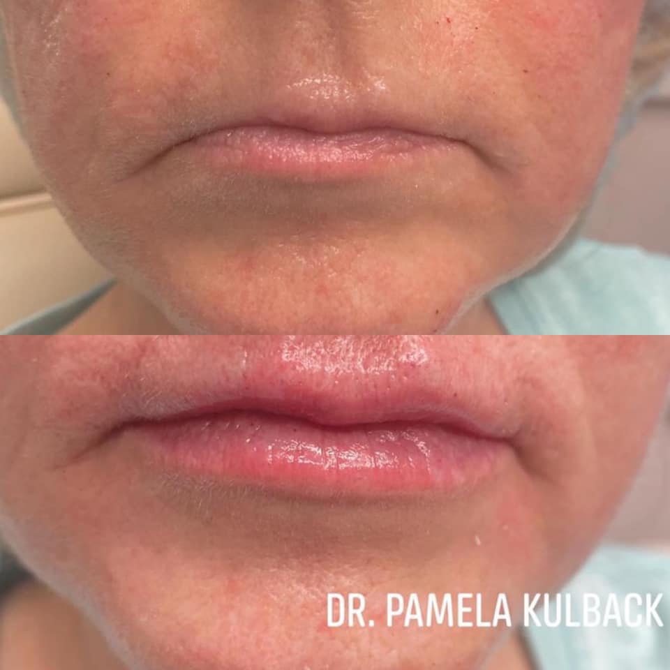 LIP FILLER BY DR. Pamela Kulback