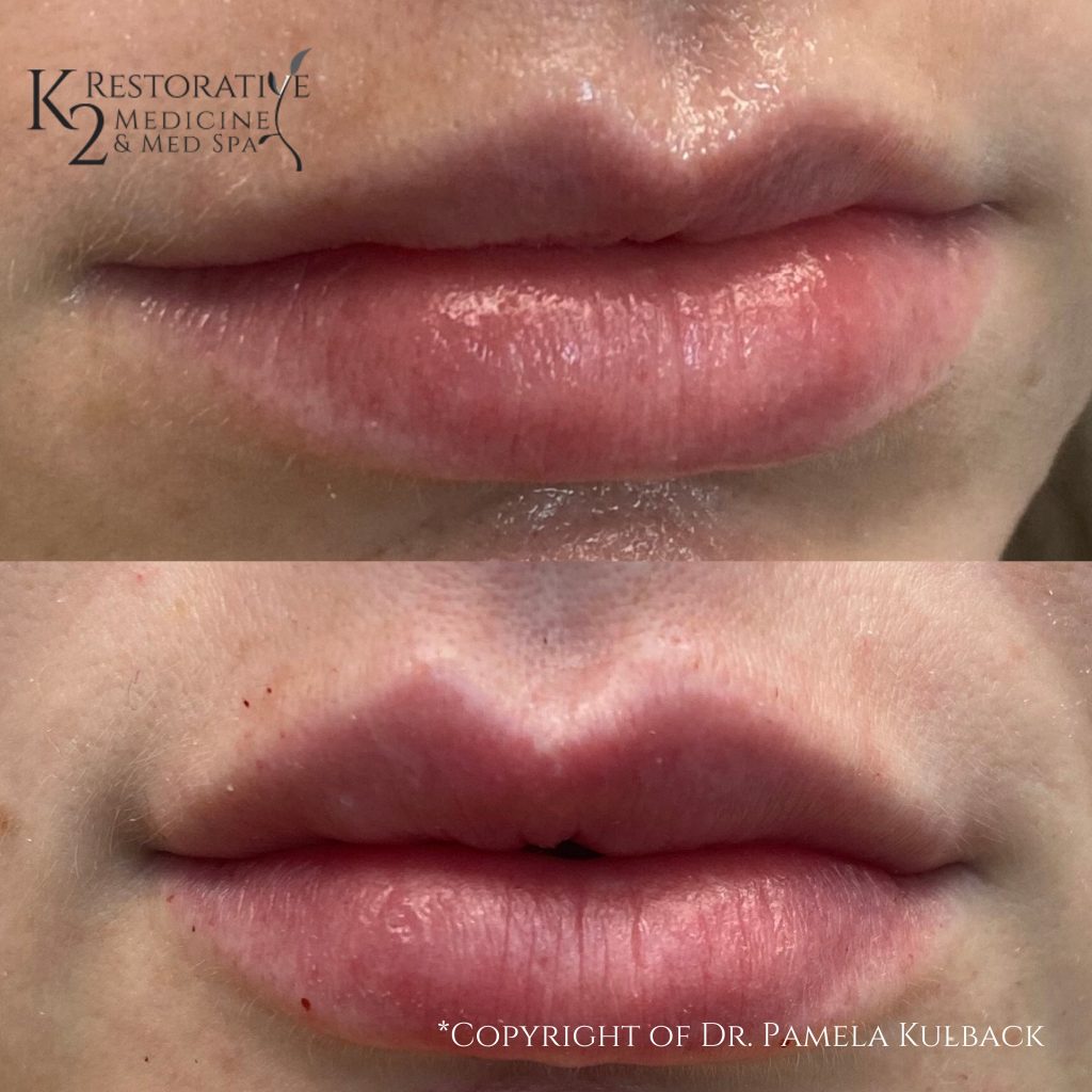 Kysse Lip Filler before and after