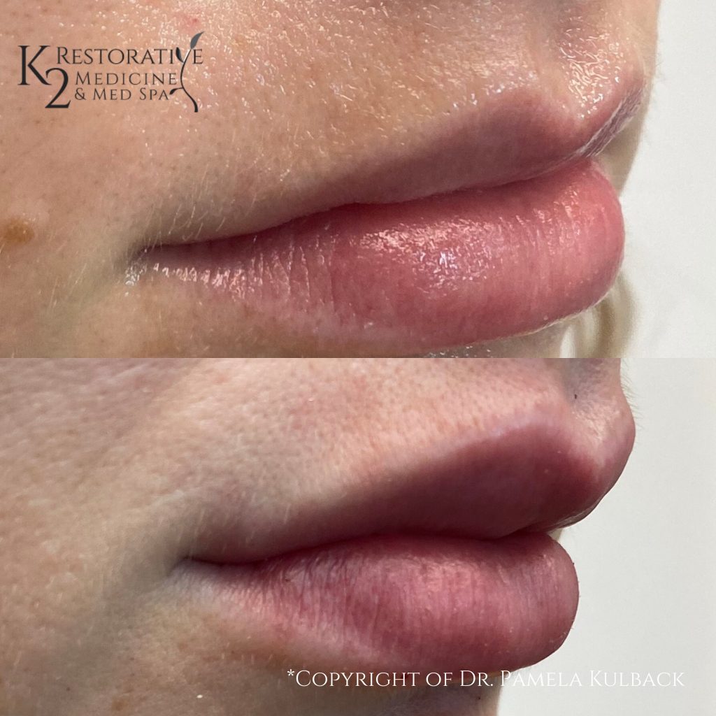 Before and after Restylane Kysse Side View