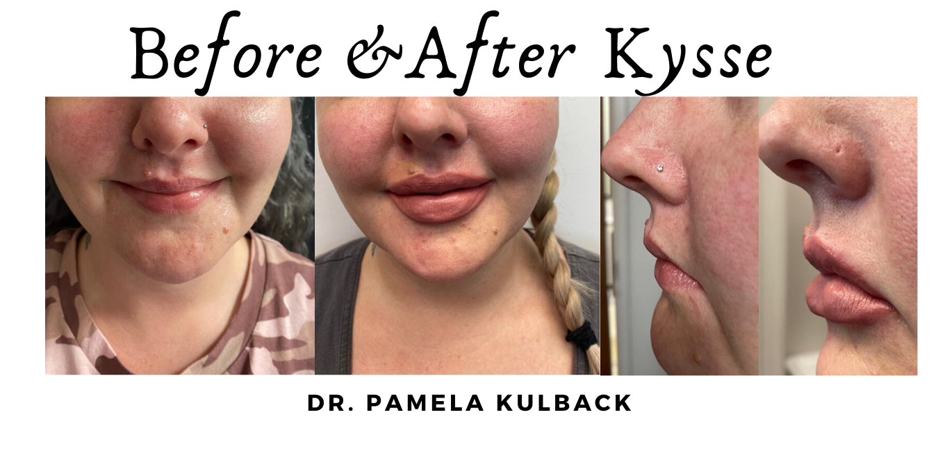 Before and after Restylane Kysse for Lips