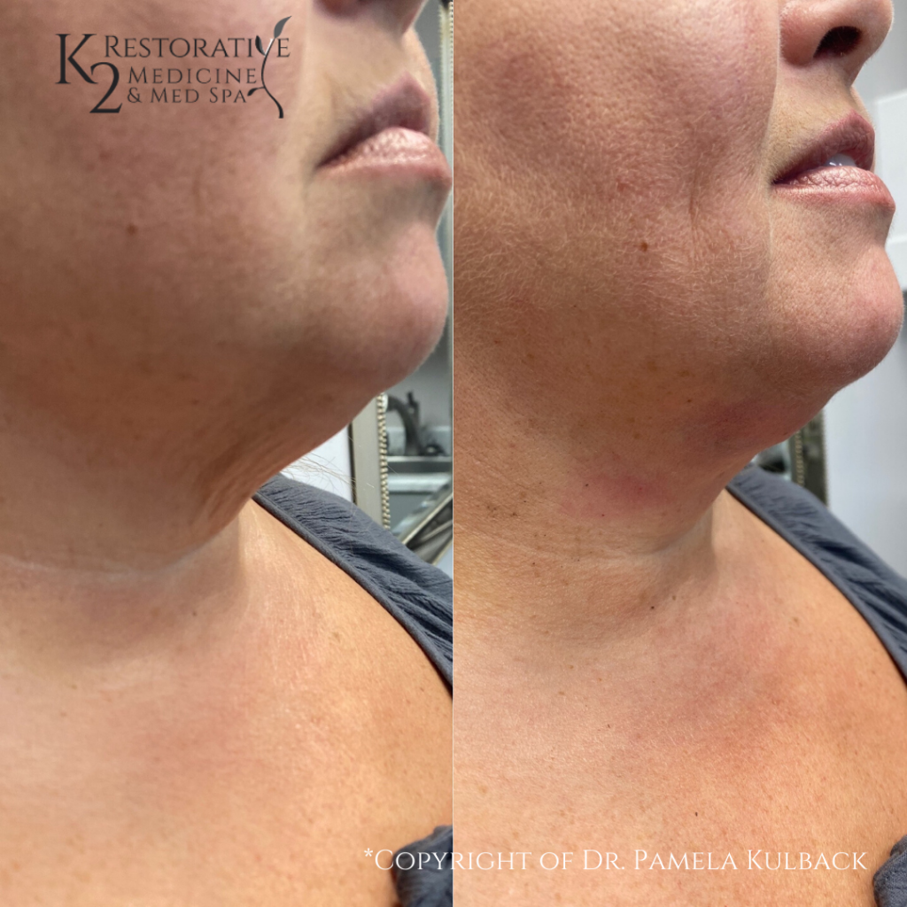 K2 Restorative Before and Afters PDO Thread Lift