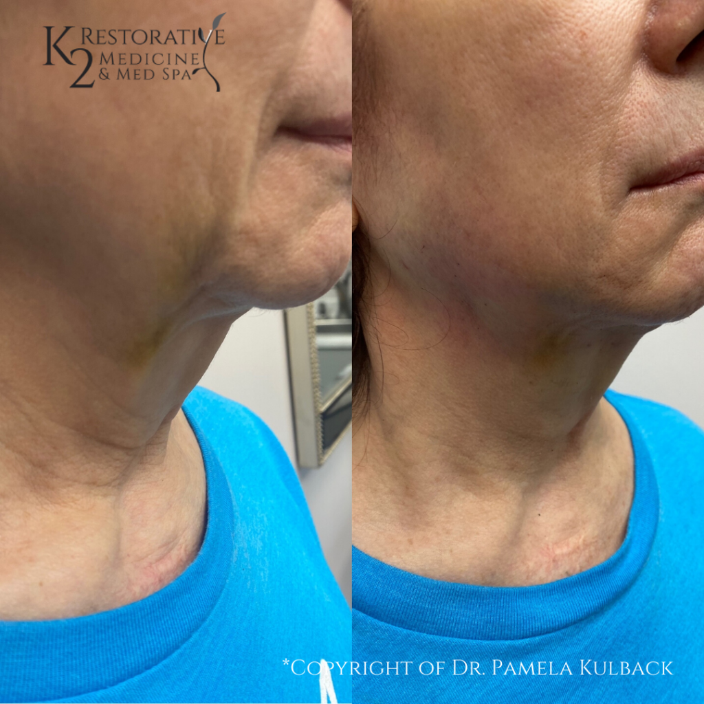 K2 Restorative Before and Afters PDO Thread Lift