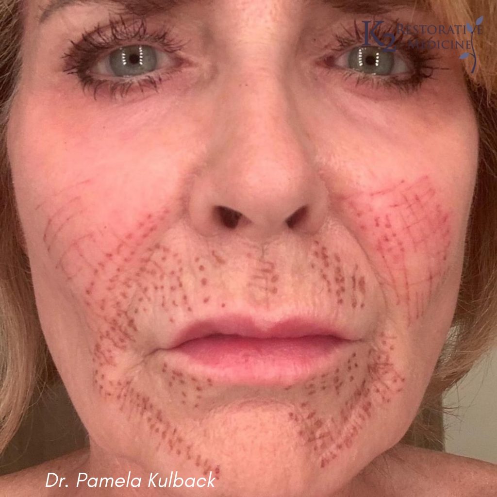 2 Days Post Subnovii Plasma Pen Treatment of the lower face by Dr. Pamela Kulback