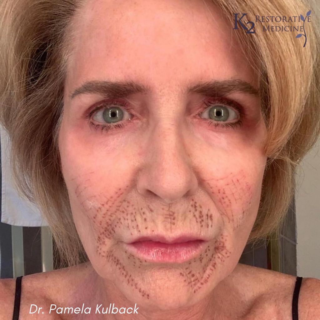 5 Days Post Subnovii Plasma Pen Treatment of the lower face by Dr. Pamela Kulback