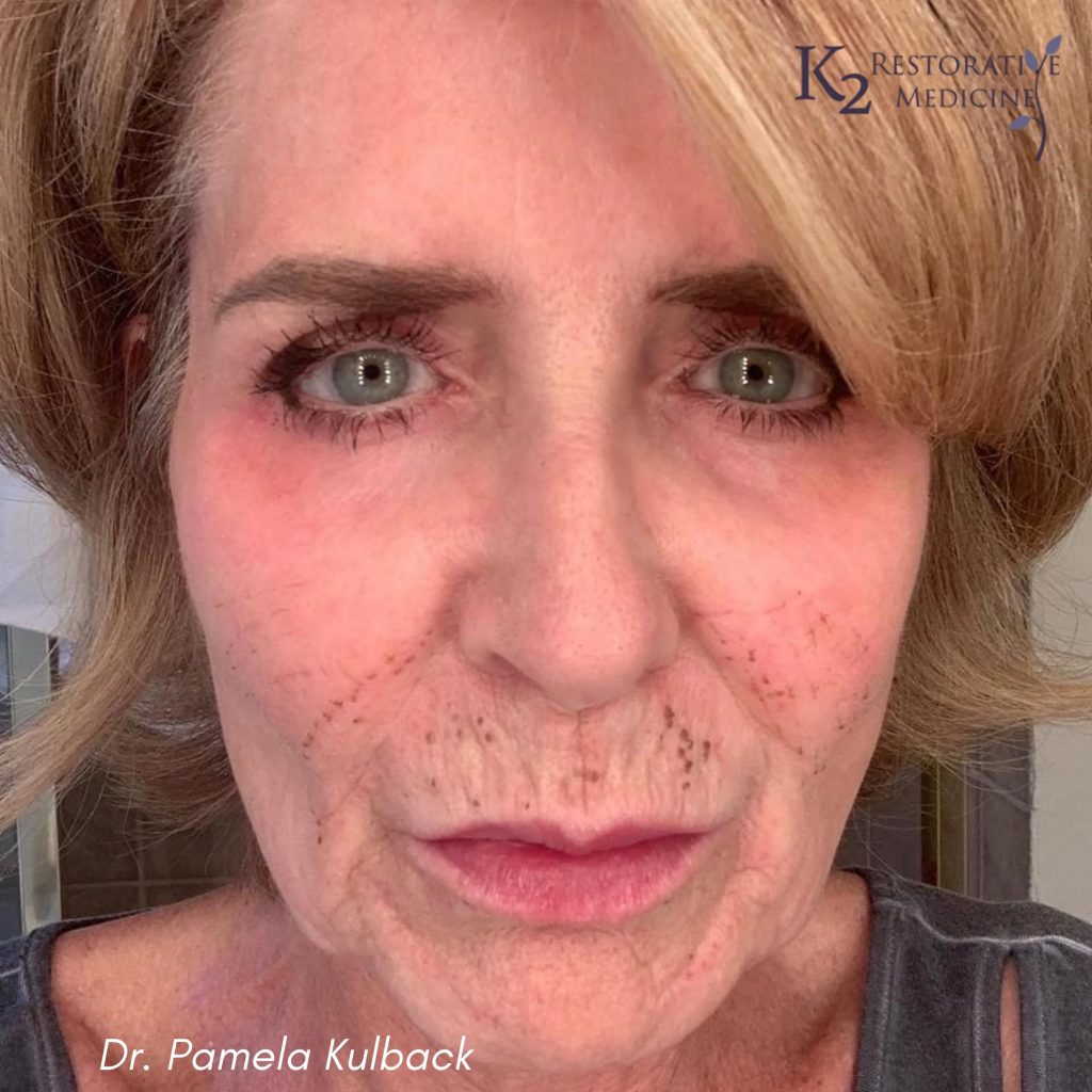 5 Days Post Subnovii Plasma Pen Treatment of the lower face by Dr. Pamela Kulback