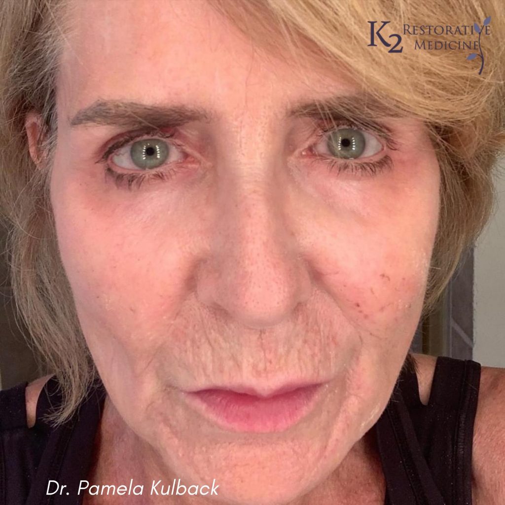 7 Days Post Subnovii Plasma Pen Treatment of the lower face by Dr. Pamela Kulback