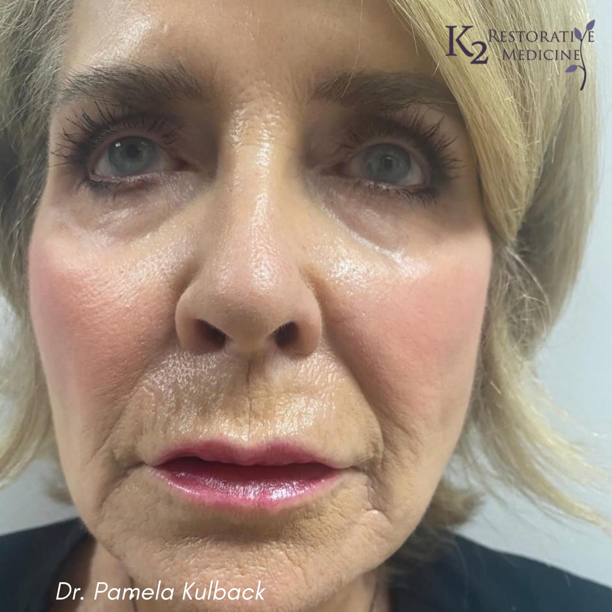 12 Days Post Subnovii Plasma Pen Treatment of the lower face by Dr. Pamela Kulback