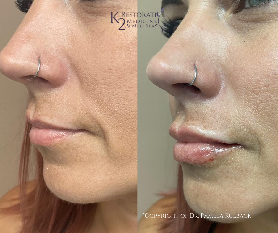 Before and after one syringe of Restylane Kysse for added volume and softness