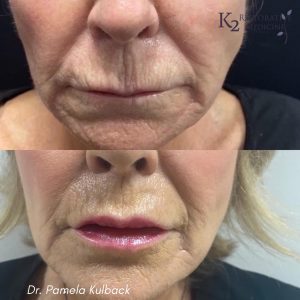 Before and After Plasma Pen Treatment