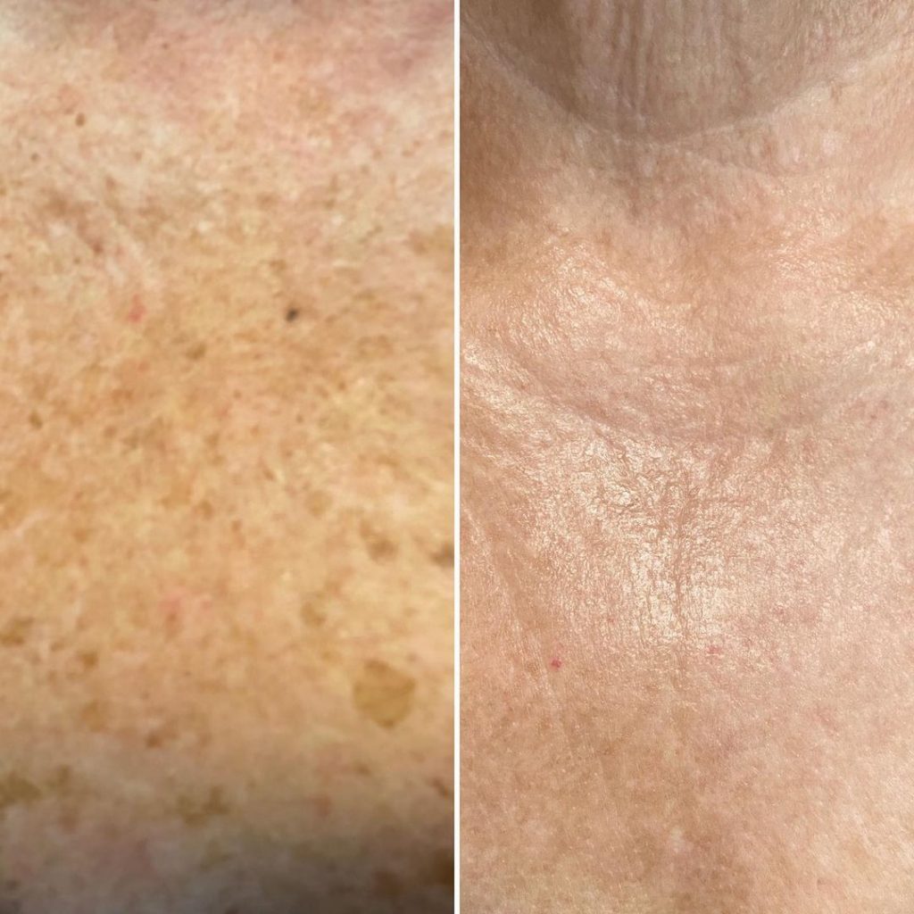 IPL Therapy for Age spots, freckles and sun spots