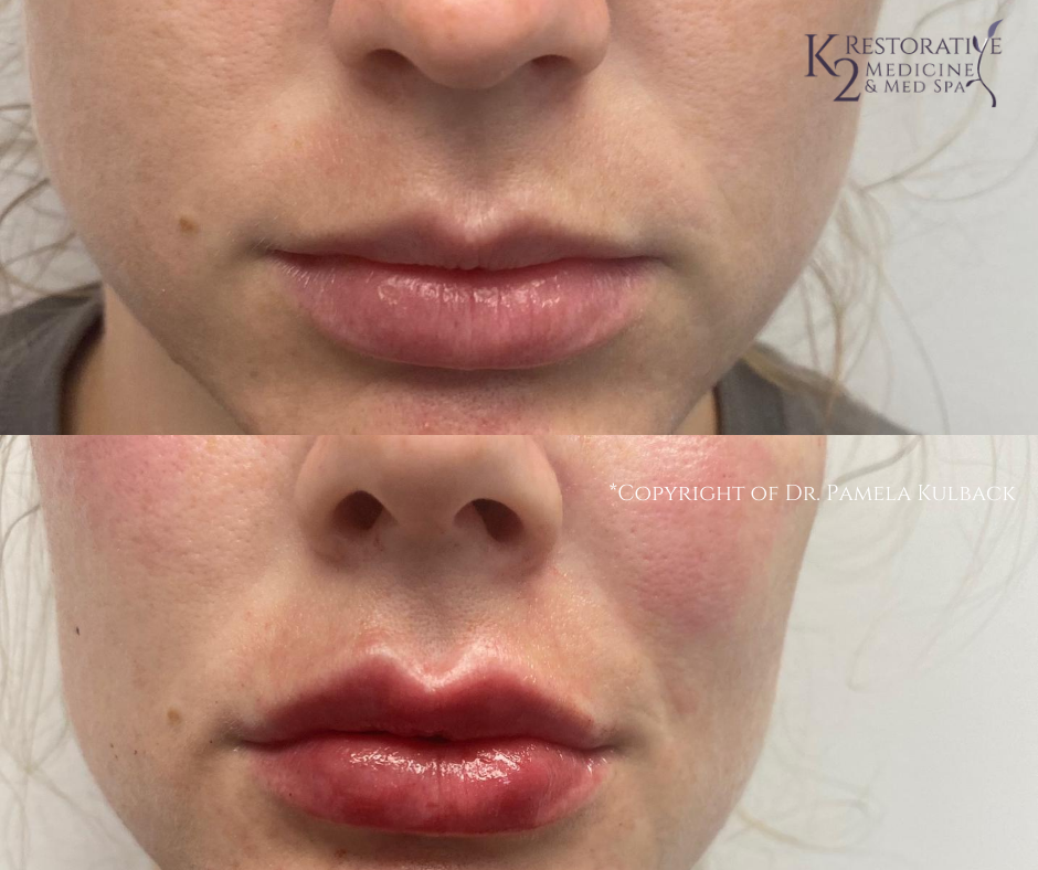 Before and after Restylane Kysse for Lip Enhancement and Restylane Lyft for cheeks - mid face filler