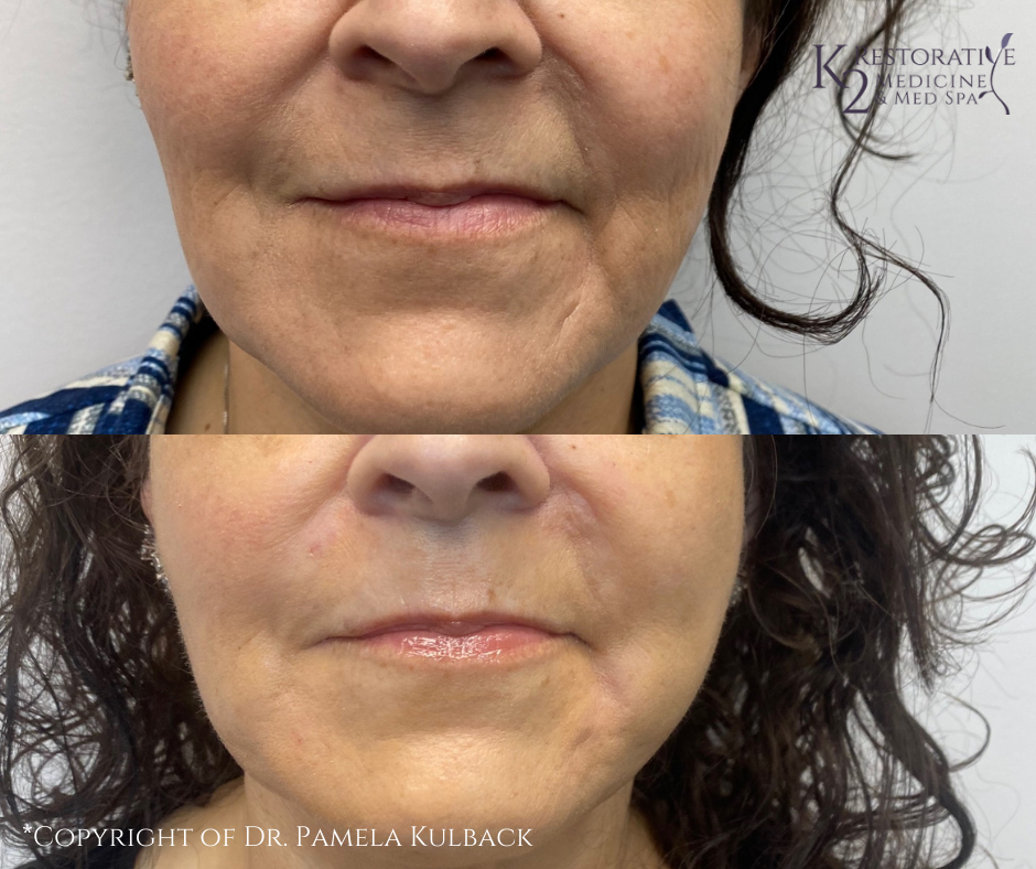 Before and after PDO Thread-Lift of the face and neck by Dr. Pamela Kulback